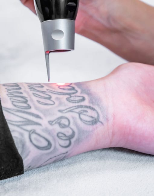 removal tattoo removal