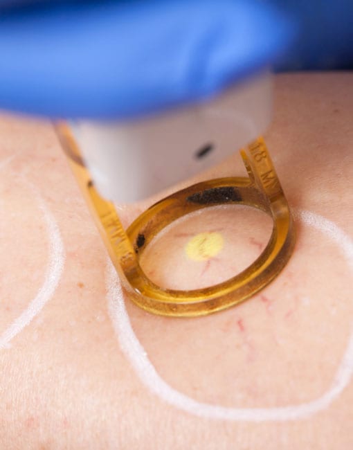 spider vein treatment